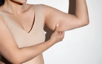 Can an Arm Lift Get Rid of ‘Bat Wings’?