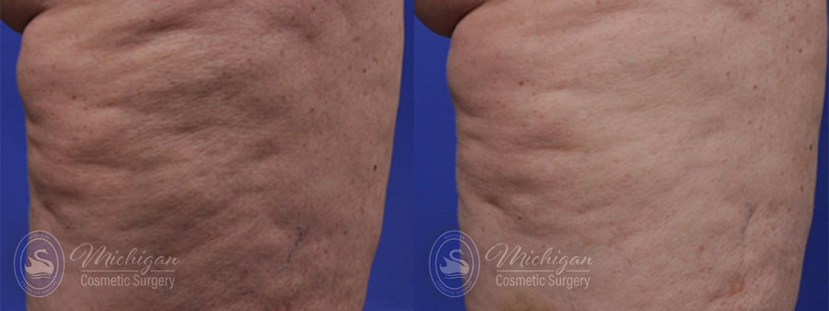 cellulite before after image