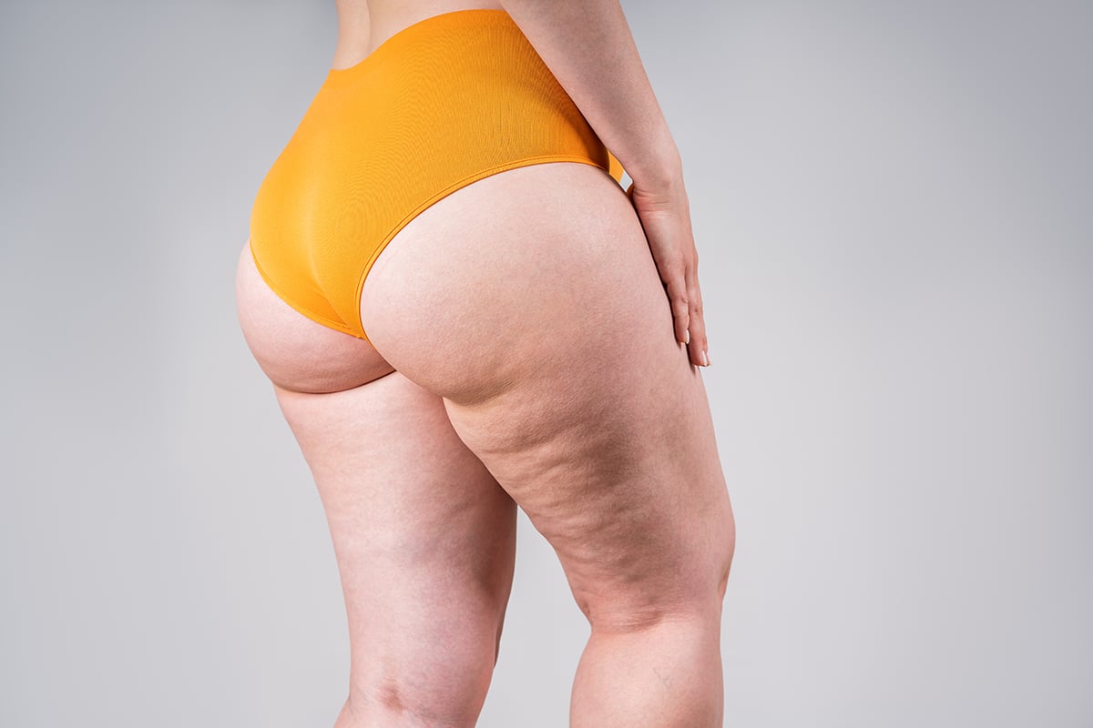 obese female body with cellulite obese female body with cellulite