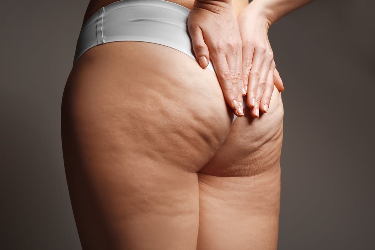 woman with cellulite problem woman with cellulite problem