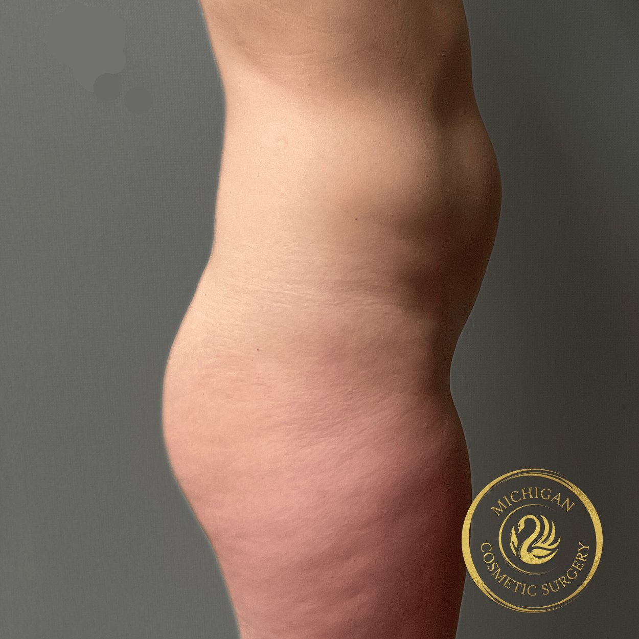 liposuction before photo by michigan cosmetic surgery in southfield mi