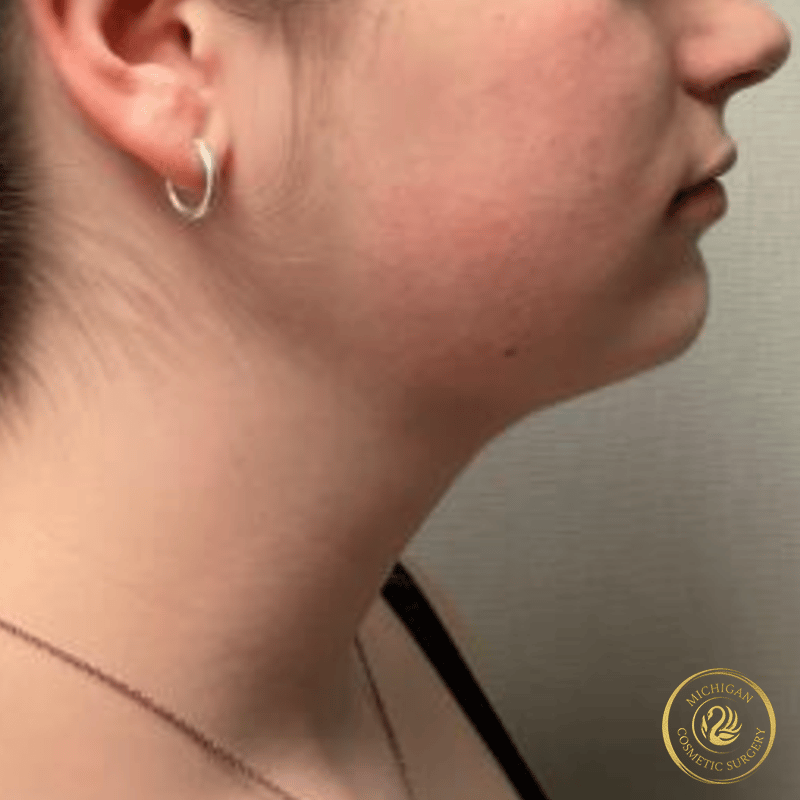 chin liposuction after photo by michigan cosmetic surgery in southfield mi