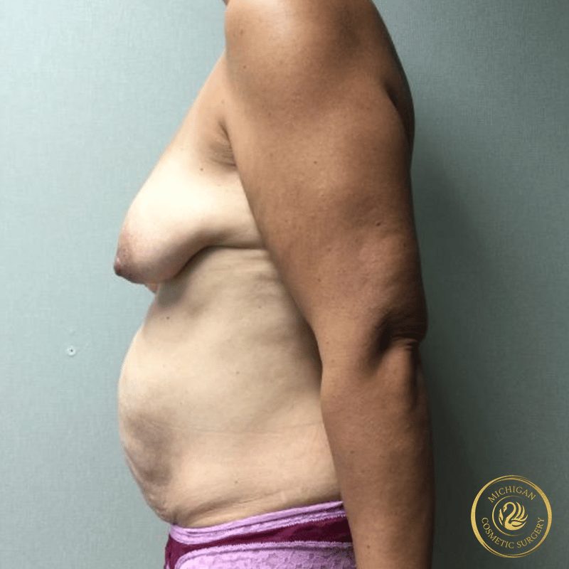 mommy makeover before photo by michigan cosmetic surgery in southfield mi