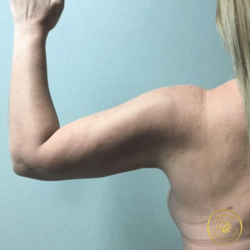 liposuction after photo by michigan cosmetic surgery in southfield mi