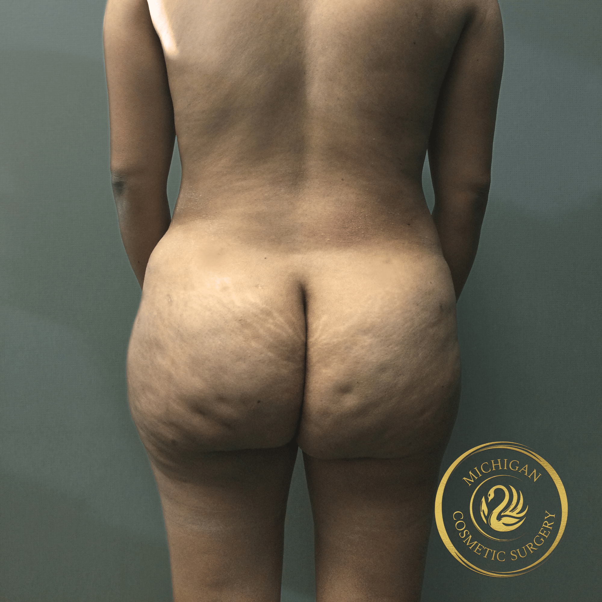 brazilian butt lift after photo by michigan cosmetic surgery in southfield mi