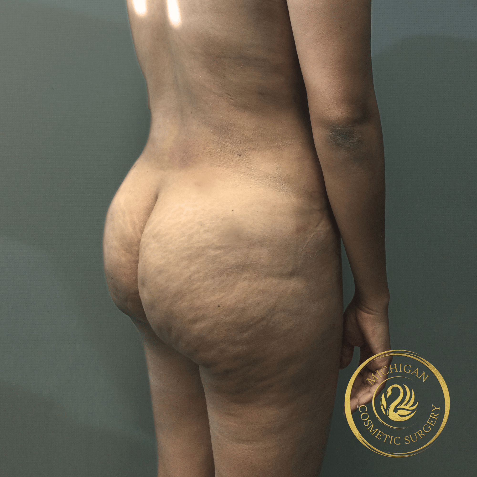 brazilian butt lift after photo by michigan cosmetic surgery in southfield mi