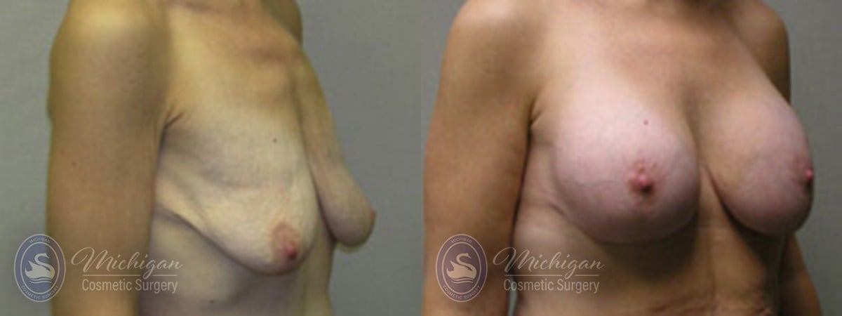 Michigan Cosmetic Surgery Southfield Breast Augmentation Medium Lift P