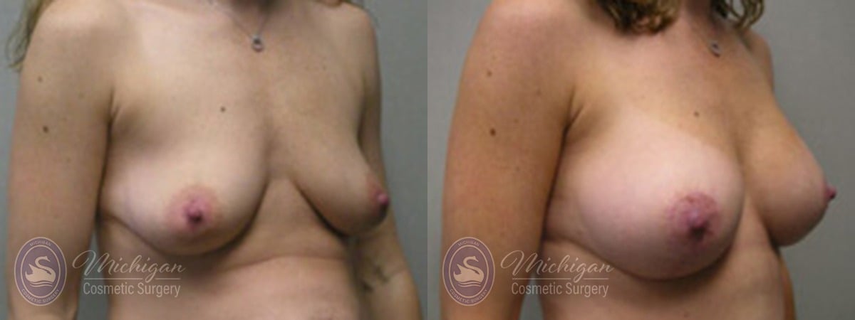 Michigan Cosmetic Surgery Southfield Breast Augmentation Medium Lift P