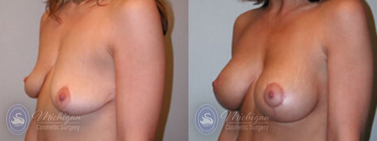 Michigan Cosmetic Surgery Southfield Breast Augmentation Medium Lift P