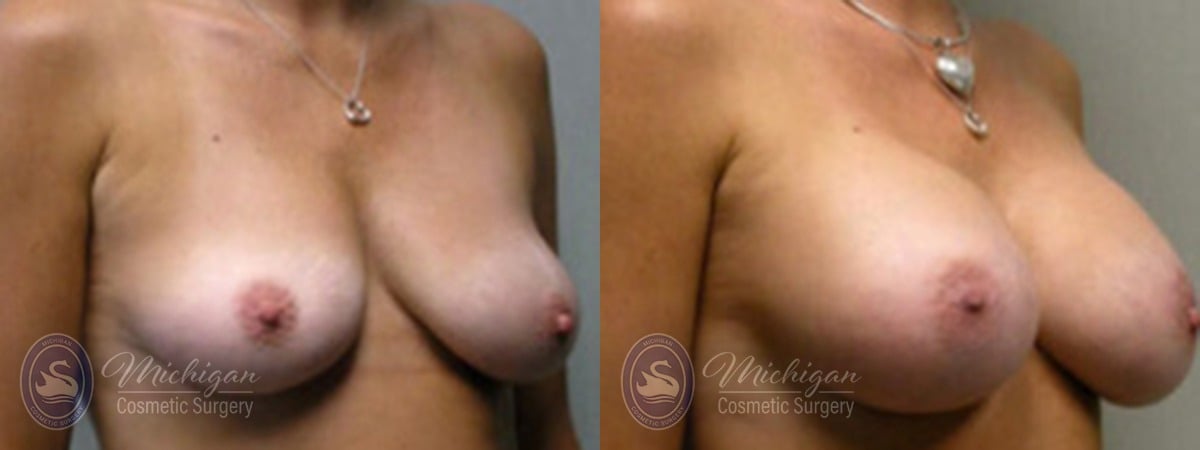 Michigan Cosmetic Surgery Southfield Breast Augmentation small lift P