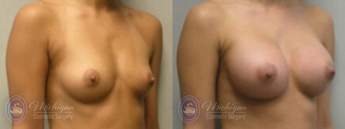Michigan Cosmetic Surgery Southfield Breast Augmentation P