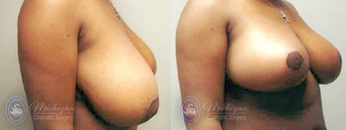 Michigan Cosmetic Surgery Southfield Breast Reduction P