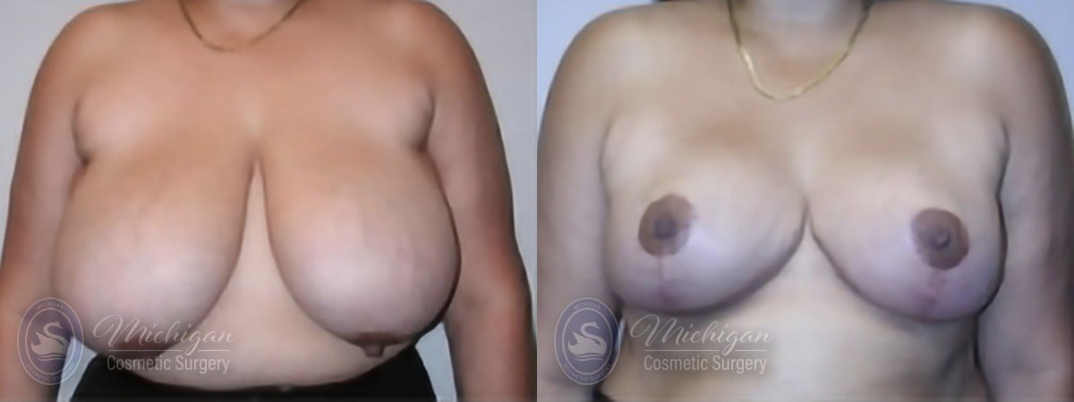 Michigan Cosmetic Surgery Southfield Breast Reduction P A