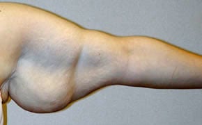 arm lift before photo by michigan cosmetic surgery in southfield mi