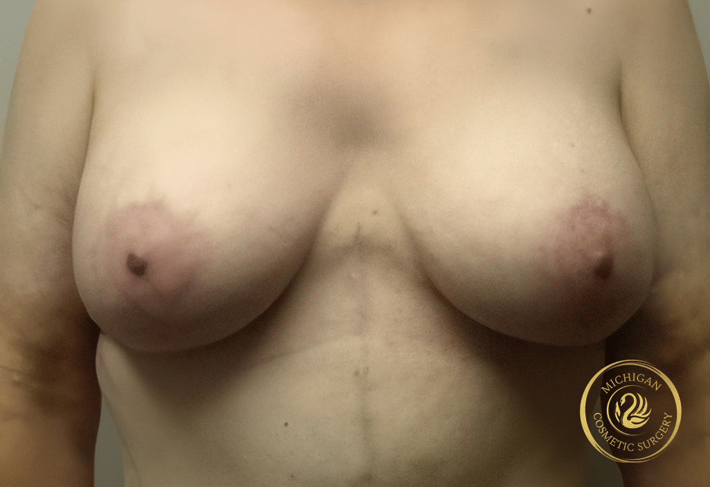 breast augmentation and lift after photo by michigan cosmetic surgery in southfield mi