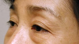 blepharoplasty before photo by michigan cosmetic surgery in southfield mi