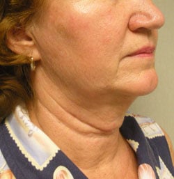facelift before photo by michigan cosmetic surgery in southfield mi