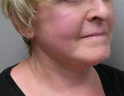facelift after photo by michigan cosmetic surgery in southfield mi