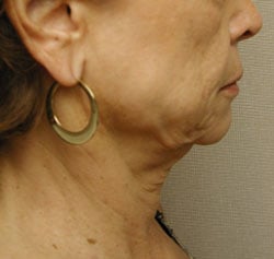 facelift before photo by michigan cosmetic surgery in southfield mi