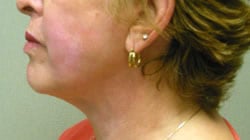 facelift after photo by michigan cosmetic surgery in southfield mi