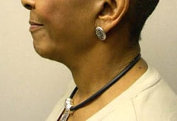 facelift after photo by michigan cosmetic surgery in southfield mi