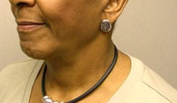 facelift after photo by michigan cosmetic surgery in southfield mi