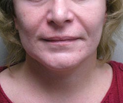 facelift after photo by michigan cosmetic surgery in southfield mi