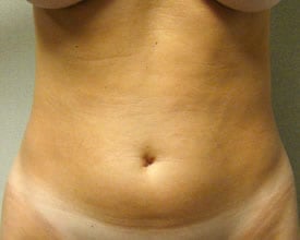 liposuction before photo by michigan cosmetic surgery in southfield mi