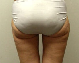 liposuction after photo by michigan cosmetic surgery in southfield mi