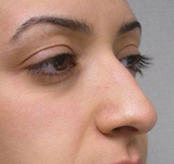 rhinoplasty before photo by michigan cosmetic surgery in southfield mi