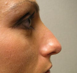 rhinoplasty before photo by michigan cosmetic surgery in southfield mi