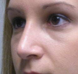 rhinoplasty after photo by michigan cosmetic surgery in southfield mi