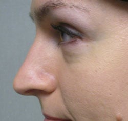 rhinoplasty before photo by michigan cosmetic surgery in southfield mi