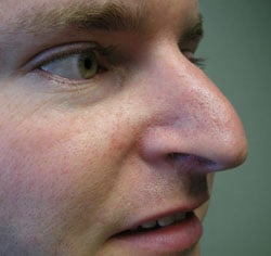 rhinoplasty before photo by michigan cosmetic surgery in southfield mi
