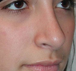 rhinoplasty after photo by michigan cosmetic surgery in southfield mi