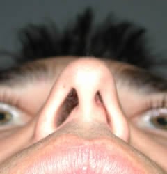 rhinoplasty before photo by michigan cosmetic surgery in southfield mi