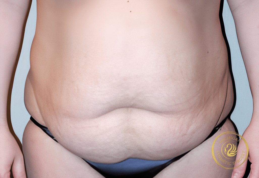 tummy tuck after photo by michigan cosmetic surgery in southfield mi tummy tuck before photo by michigan cosmetic surgery in southfield mi