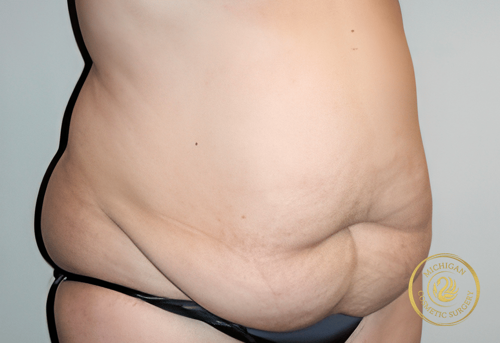 tummy tuck after photo by michigan cosmetic surgery in southfield mi tummy tuck before photo by michigan cosmetic surgery in southfield mi