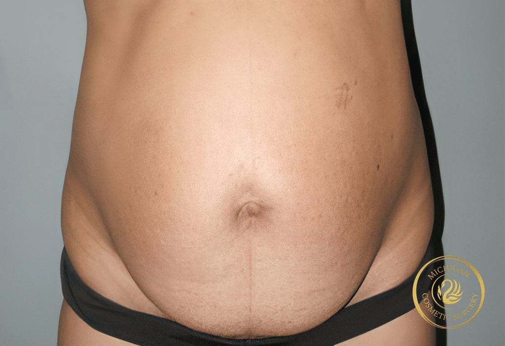 tummy tuck before photo by michigan cosmetic surgery in southfield mi tummy tuck before photo by michigan cosmetic surgery in southfield mi