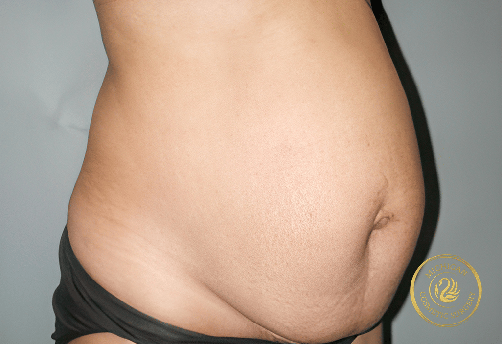 tummy tuck before photo by michigan cosmetic surgery in southfield mi tummy tuck before photo by michigan cosmetic surgery in southfield mi