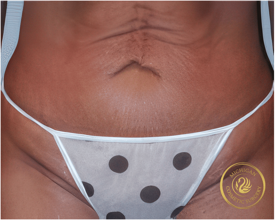 tummy tuck before photo by michigan cosmetic surgery in southfield mi tummy tuck before photo by michigan cosmetic surgery in southfield mi
