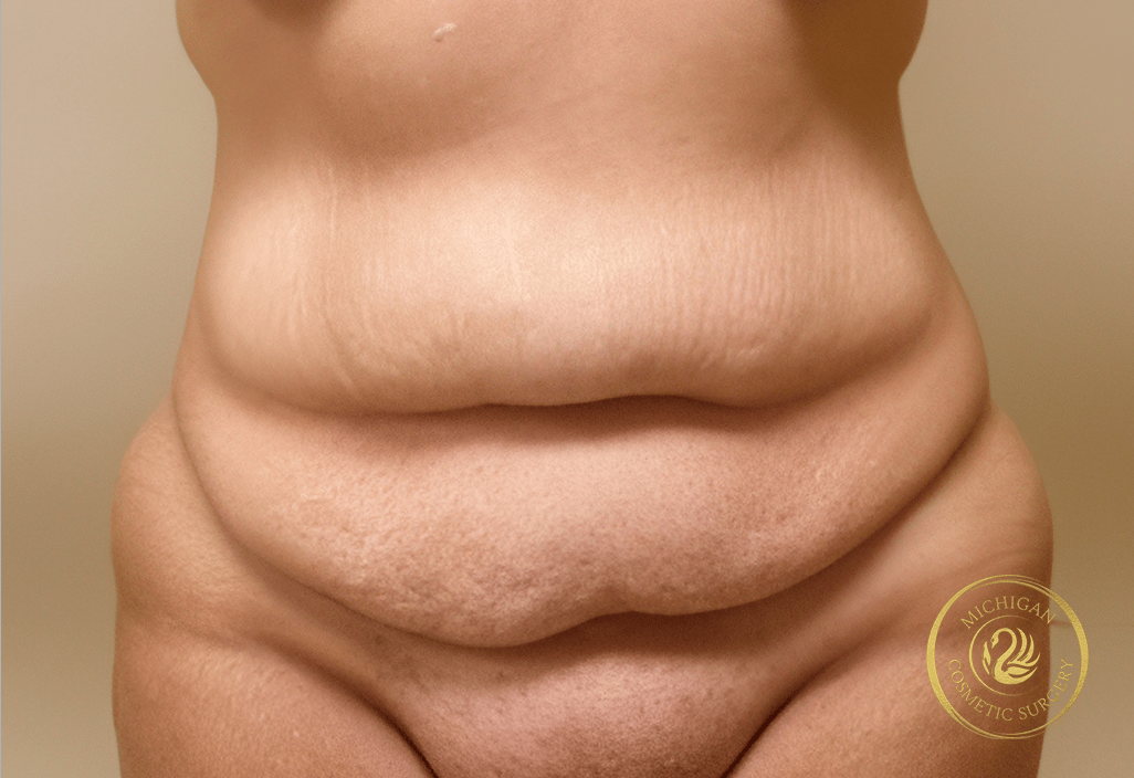 tummy tuck before photo by michigan cosmetic surgery in southfield mi tummy tuck before photo by michigan cosmetic surgery in southfield mi