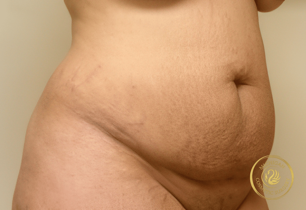 tummy tuck before photo by michigan cosmetic surgery in southfield mi tummy tuck before photo by michigan cosmetic surgery in southfield mi