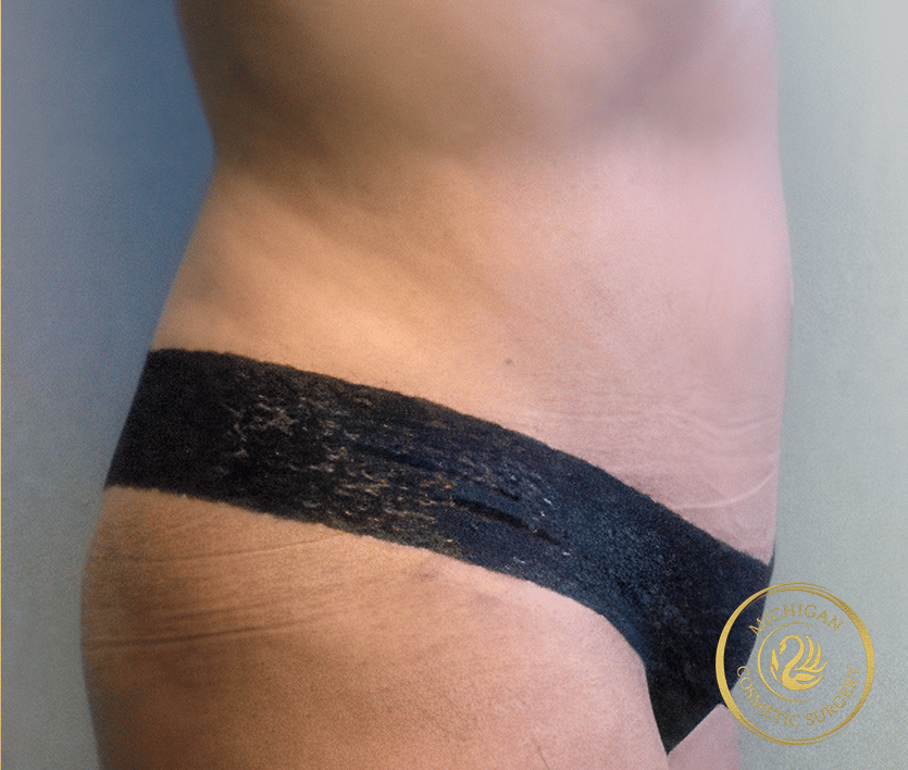 tummy tuck after photo by michigan cosmetic surgery in southfield mi
