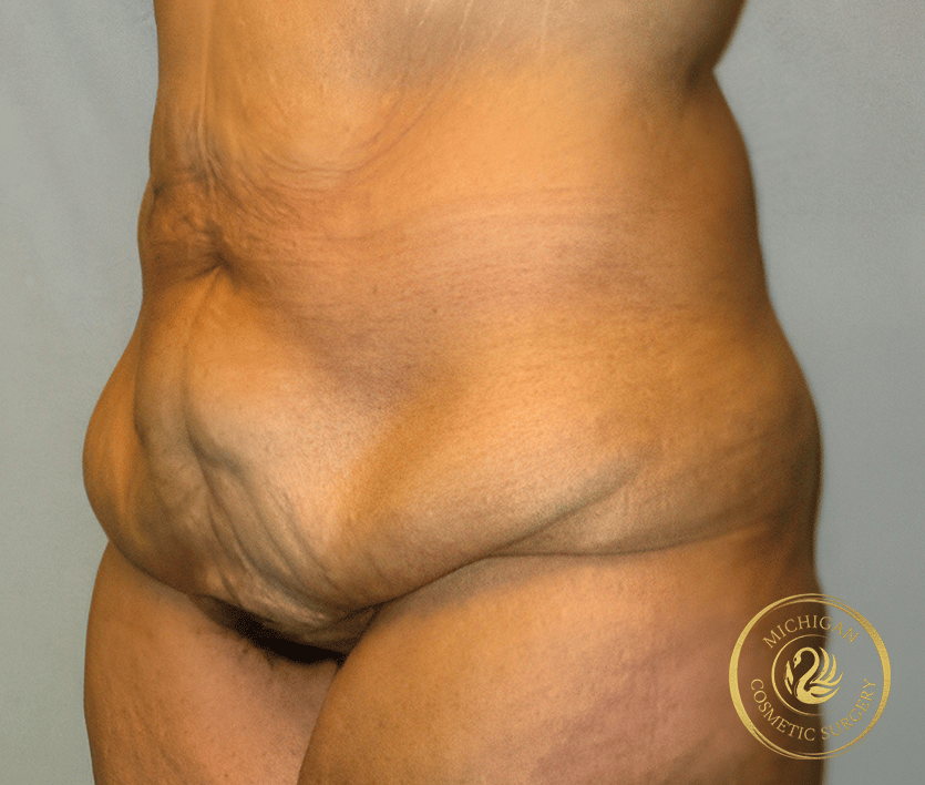 tummy tuck before photo by michigan cosmetic surgery in southfield mi tummy tuck before photo by michigan cosmetic surgery in southfield mi