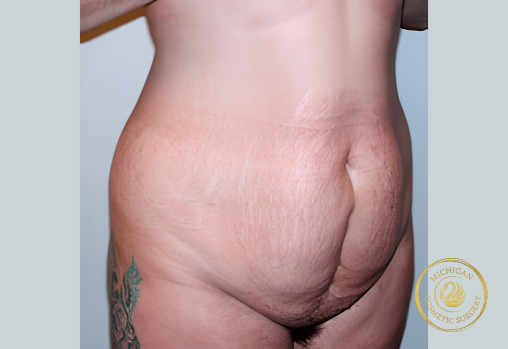 tummy tuck before photo by michigan cosmetic surgery in southfield mi
