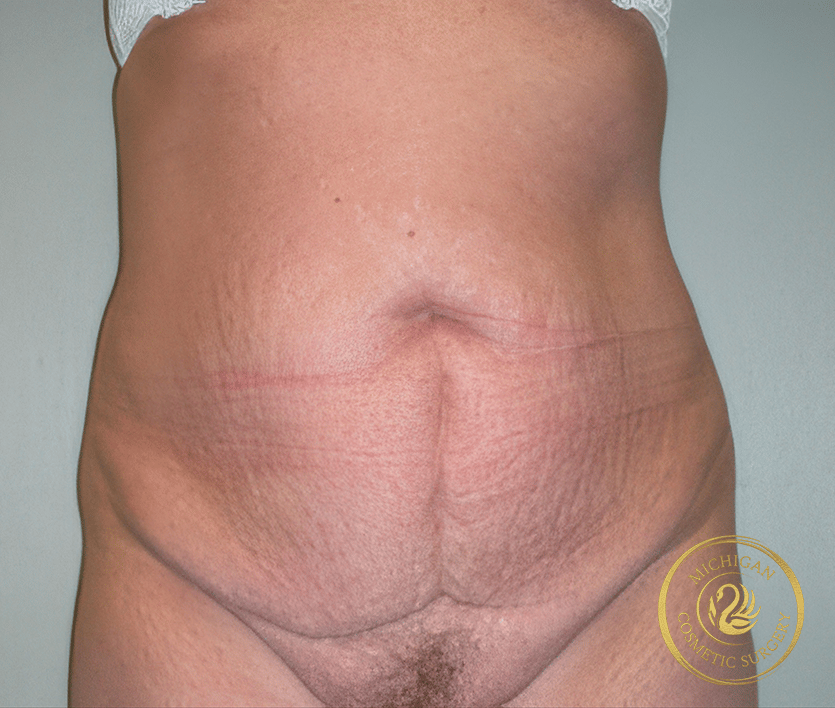 tummy tuck after photo by michigan cosmetic surgery in southfield mi tummy tuck before photo by michigan cosmetic surgery in southfield mi