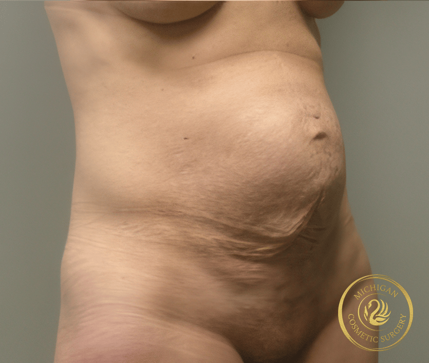 tummy tuck before photo by michigan cosmetic surgery in southfield mi tummy tuck before photo by michigan cosmetic surgery in southfield mi