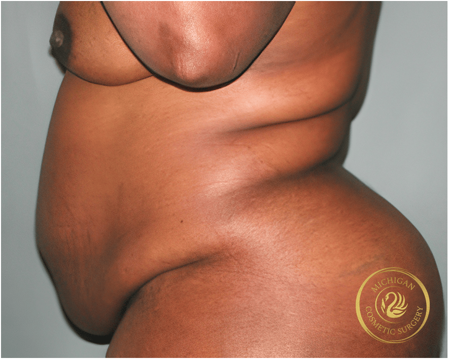 tummy tuck after photo by michigan cosmetic surgery in southfield mi tummy tuck before photo by michigan cosmetic surgery in southfield mi