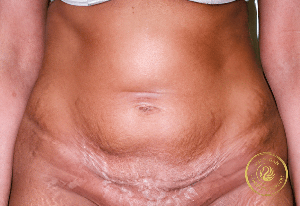 tummy tuck after photo by michigan cosmetic surgery in southfield mi tummy tuck before photo by michigan cosmetic surgery in southfield mi